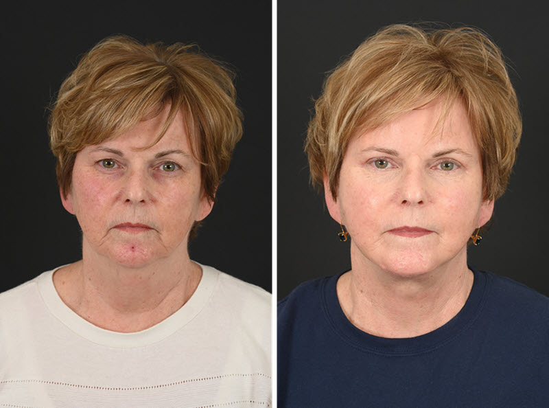 Deep plane facelift before and after