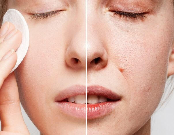 What Does A Chemical Peel Treat