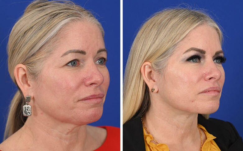 Deep plane facelift before and after