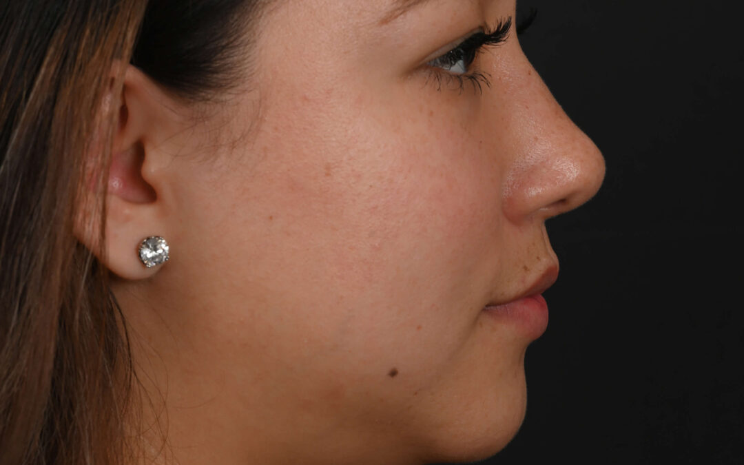 Latina rhinoplasty patient, before and after nose surgery by Houston nose surgeon Dr. Michel Siegel