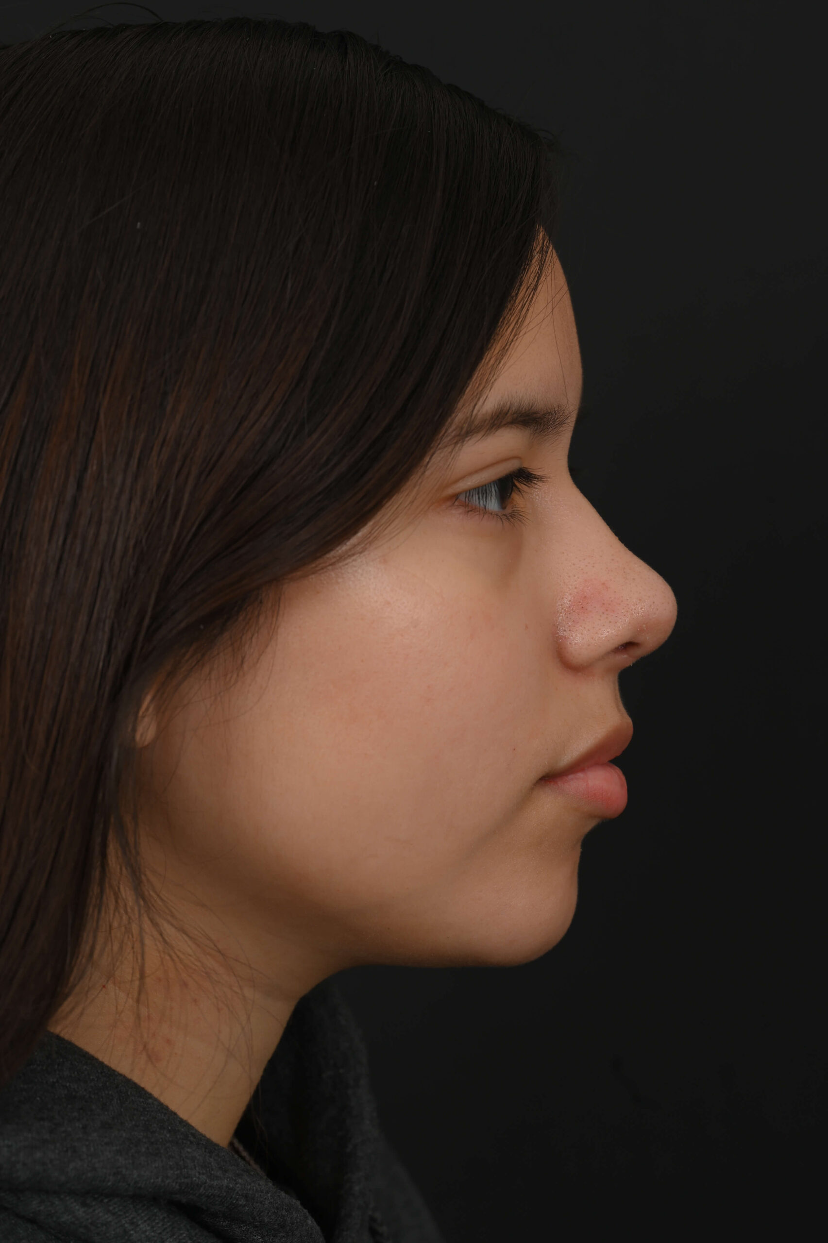 Latina rhinoplasty patient, before and after nose surgery by Houston nose surgeon Dr. Michel Siegel