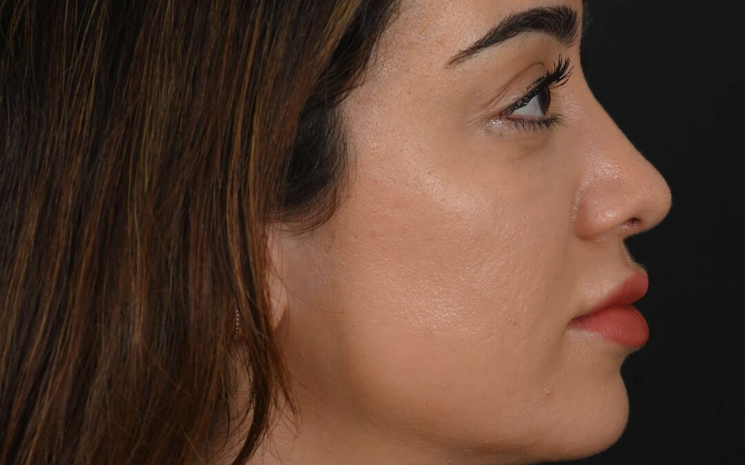 Female Middle Eastern rhinoplasty patient, before and after nose surgery by Houston nose surgeon Dr. Michel Siegel