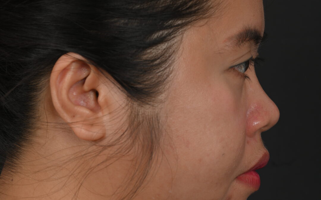 Female Asian rhinoplasty patient, before and after nose surgery by Houston nose surgeon Dr. Michel Siegel
