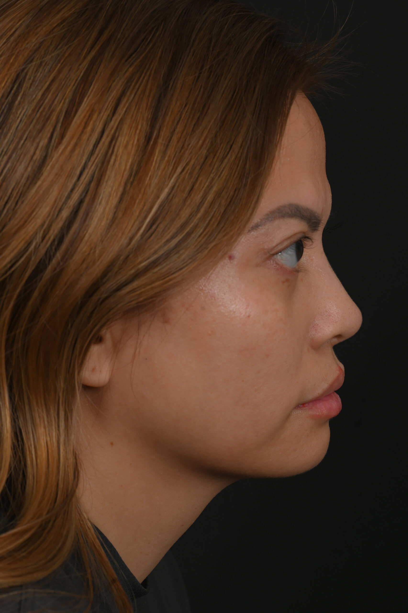 Female Asian rhinoplasty patient, before and after nose surgery by Houston nose surgeon Dr. Michel Siegel