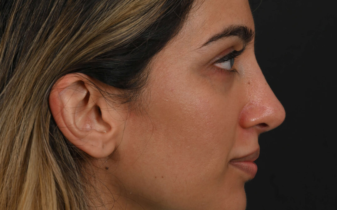 Female Middle Eastern rhinoplasty patient, before and after nose surgery by Houston nose surgeon Dr. Michel Siegel