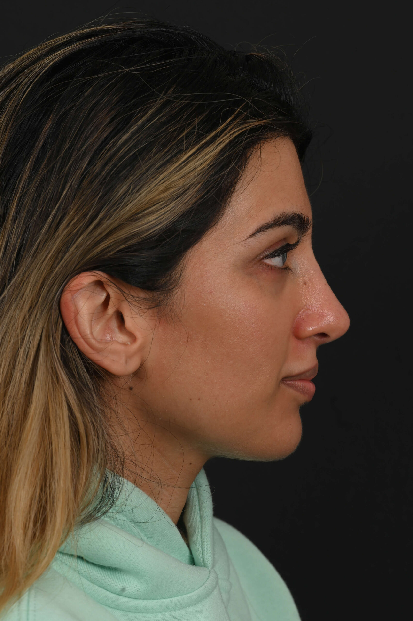 Female Middle Eastern rhinoplasty patient, before and after nose surgery by Houston nose surgeon Dr. Michel Siegel