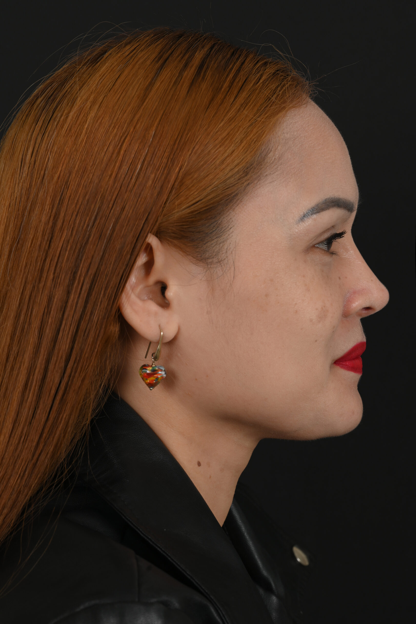 Female Asian rhinoplasty patient, before and after nose surgery by Houston nose surgeon Dr. Michel Siegel