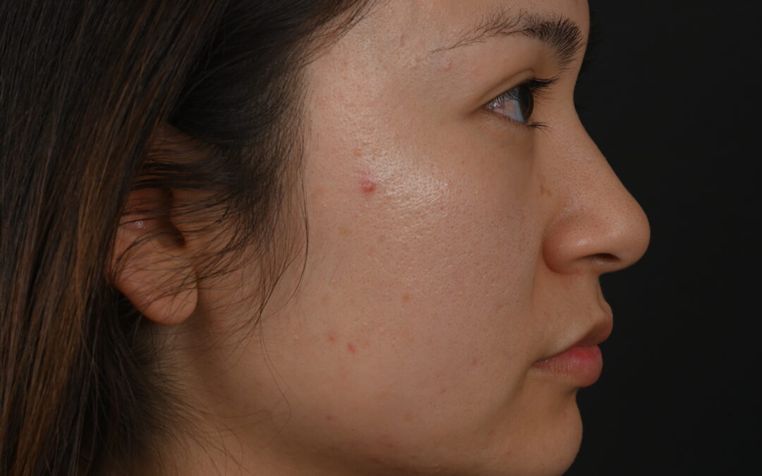 Female Asian rhinoplasty patient, before and after nose surgery by Houston nose surgeon Dr. Michel Siegel