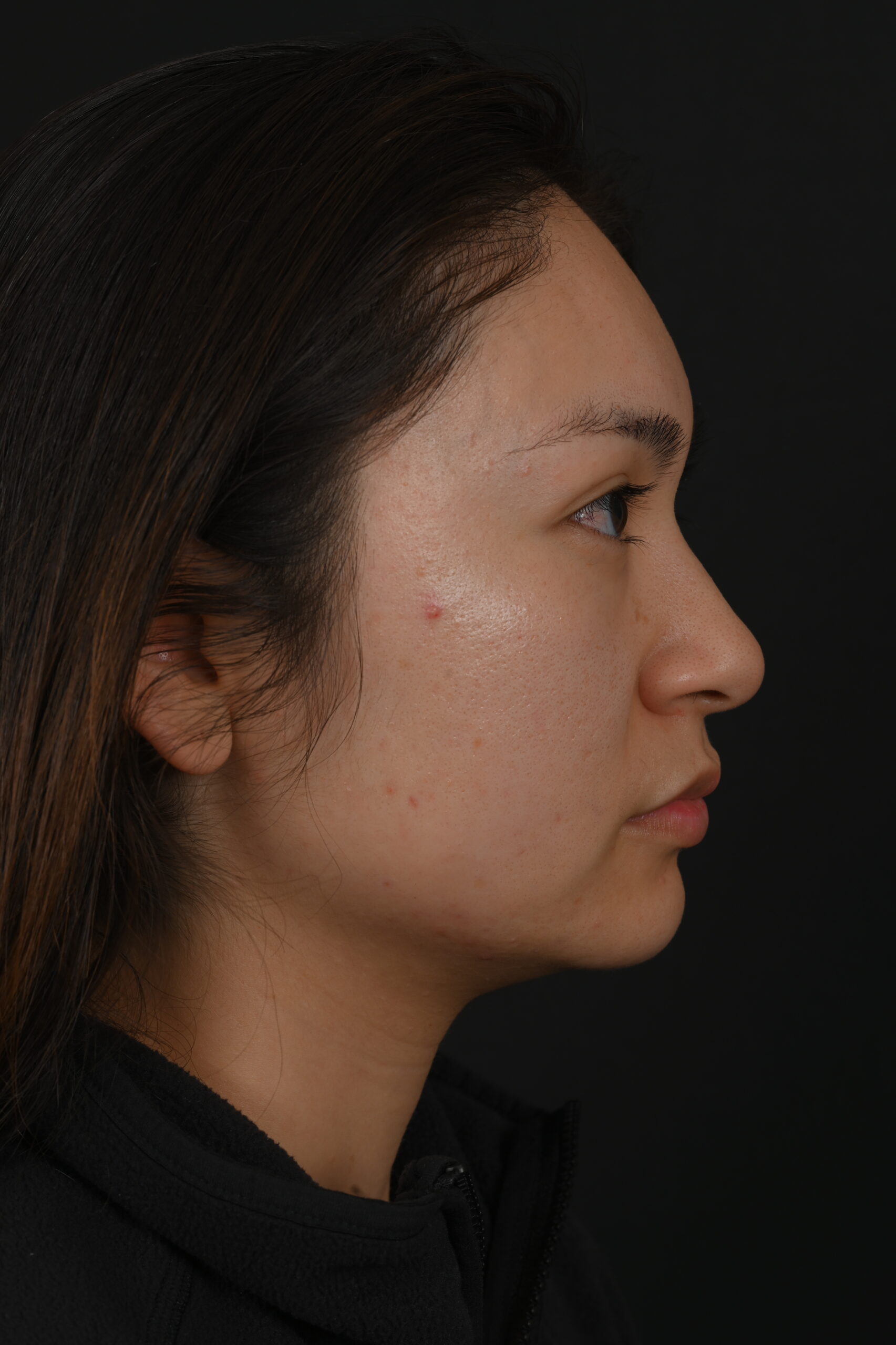 Female Asian rhinoplasty patient, before and after nose surgery by Houston nose surgeon Dr. Michel Siegel