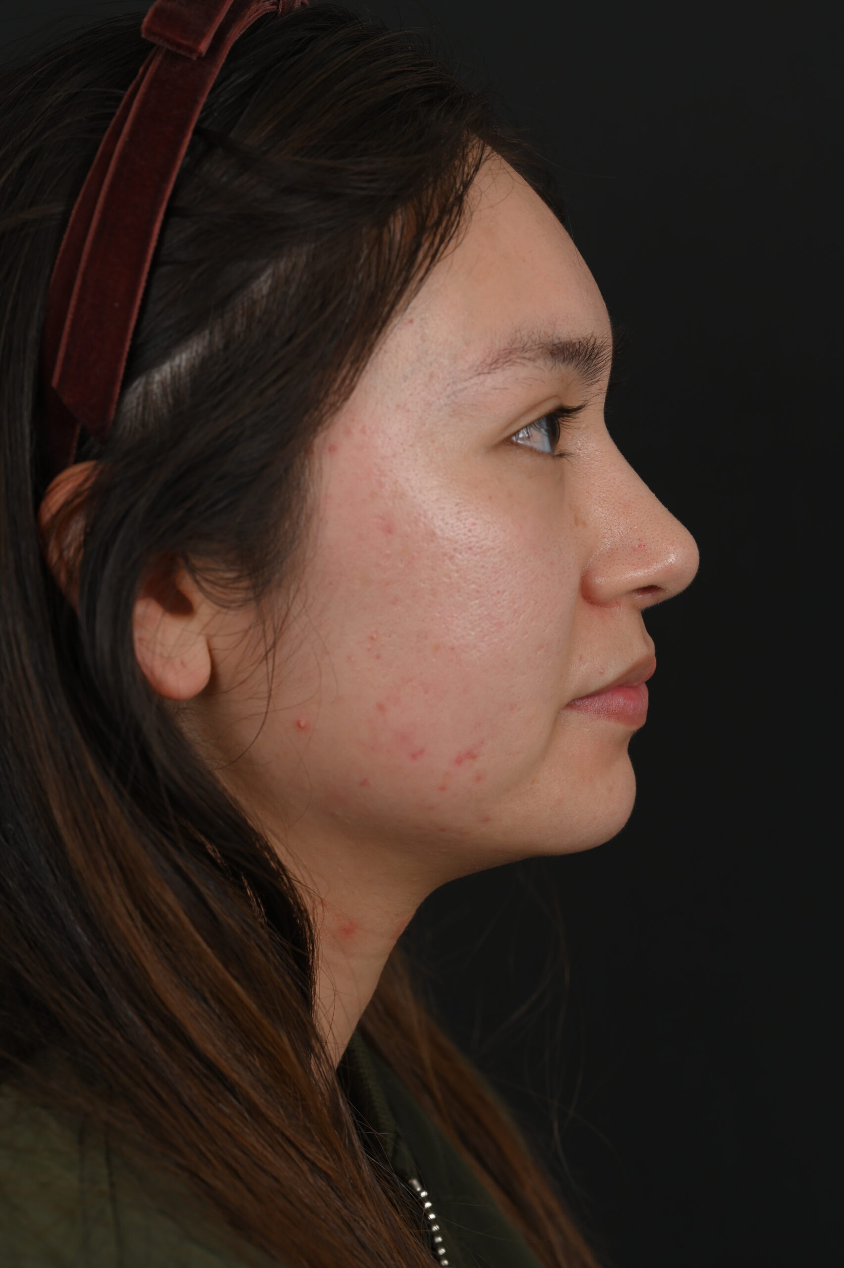 Female Asian rhinoplasty patient, before and after nose surgery by Houston nose surgeon Dr. Michel Siegel