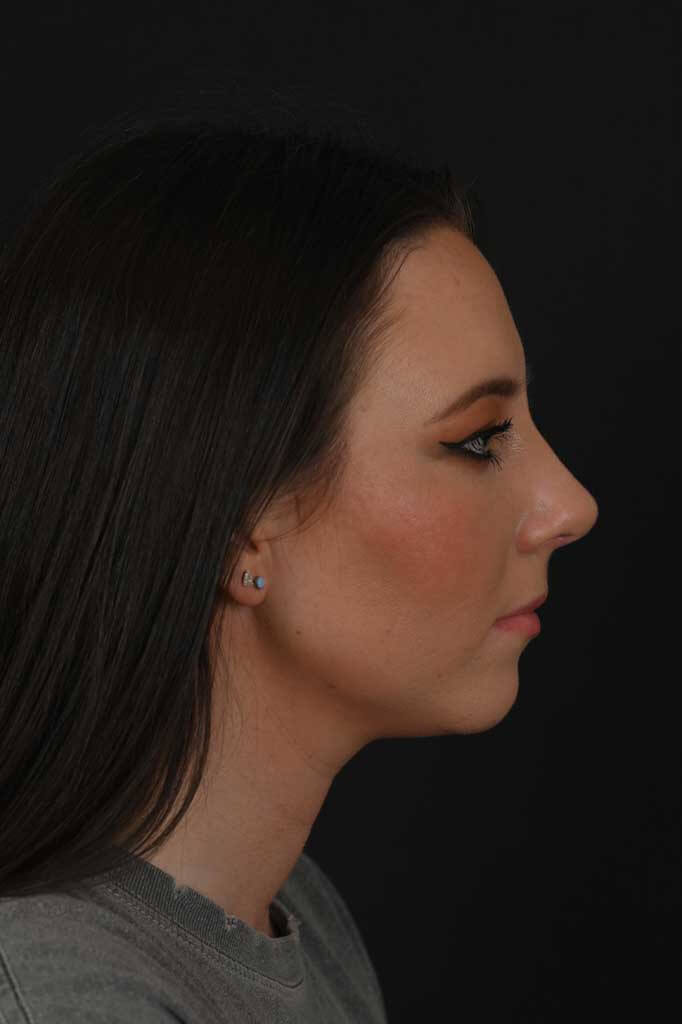 Female white rhinoplasty patient, before and after nose surgery by Houston nose surgeon Dr. Michel Siegel