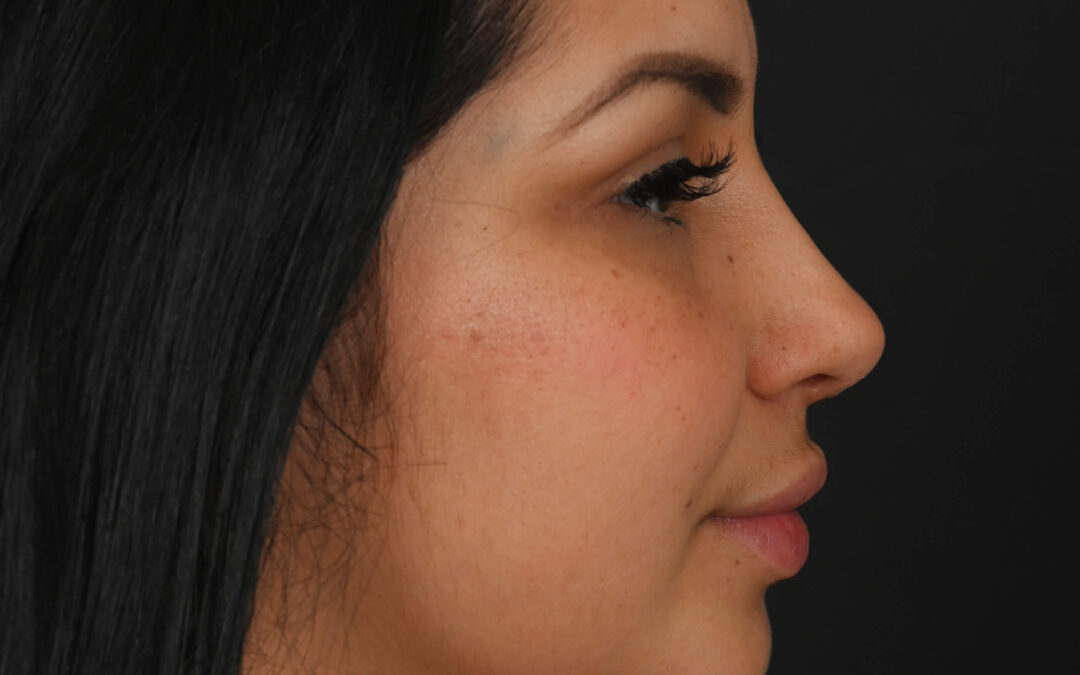 Latina rhinoplasty patient, before and after nose surgery by Houston nose surgeon Dr. Michel Siegel