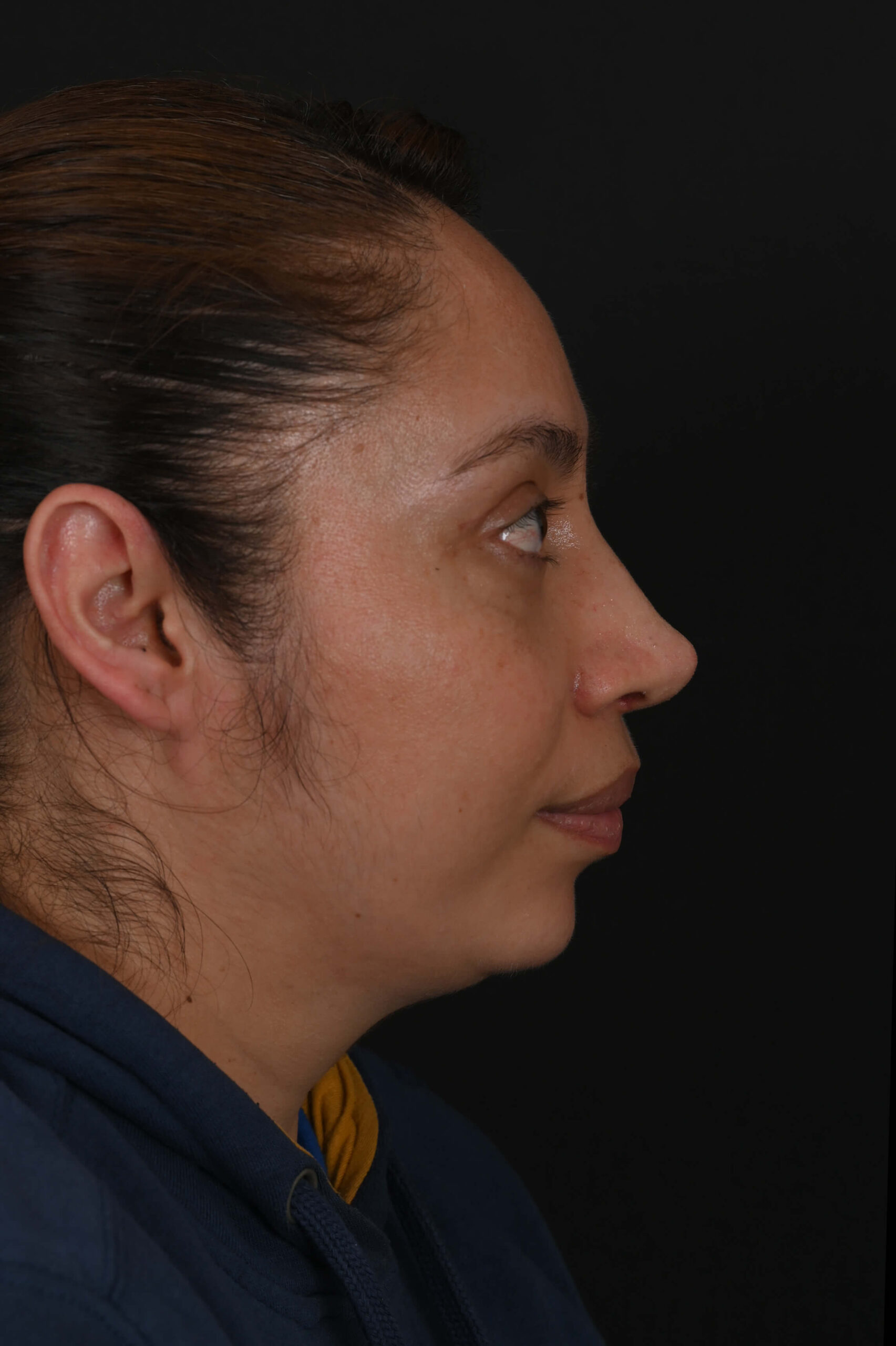 Latina rhinoplasty patient, before and after nose surgery by Houston nose surgeon Dr. Michel Siegel