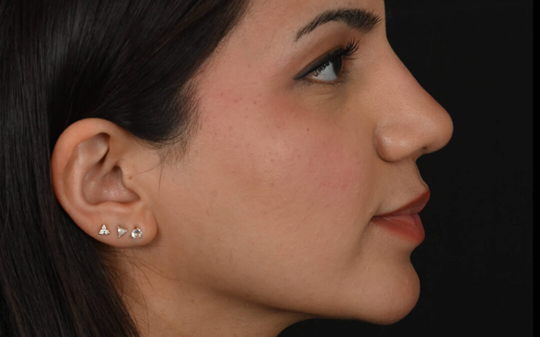 Female Middle Eastern rhinoplasty patient, before and after nose surgery by Houston nose surgeon Dr. Michel Siegel