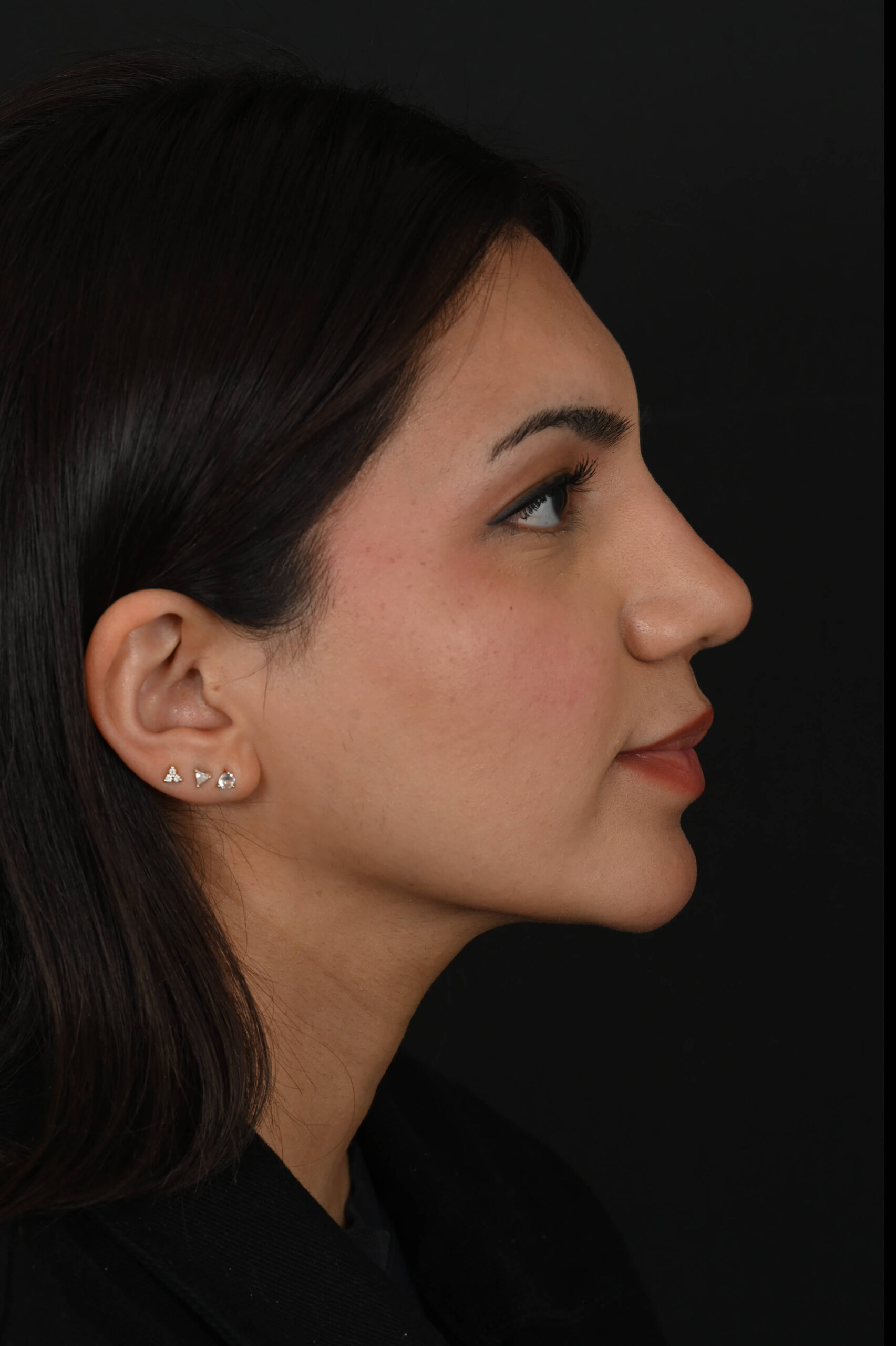 Female Middle Eastern rhinoplasty patient, before and after nose surgery by Houston nose surgeon Dr. Michel Siegel