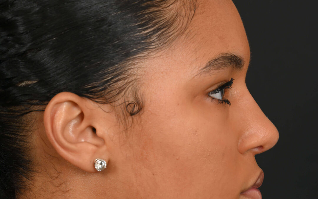 Black female rhinoplasty patient, before and after nose surgery by Houston nose surgeon Dr. Michel Siegel