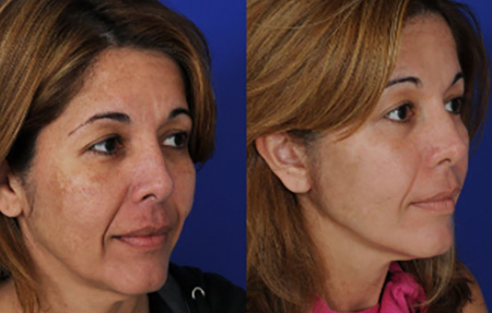 Neck lift results in Houston 