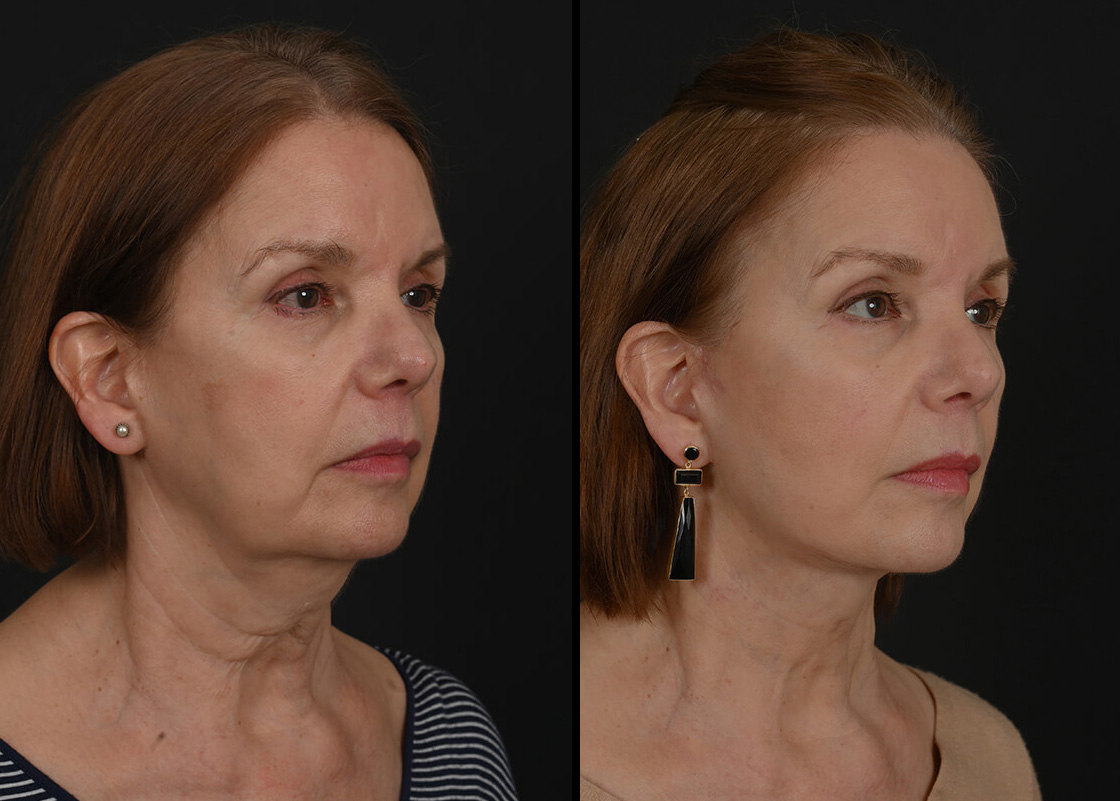 Facelift patient, before and after facelift by Houston facial surgeon Dr. Michel Siegel