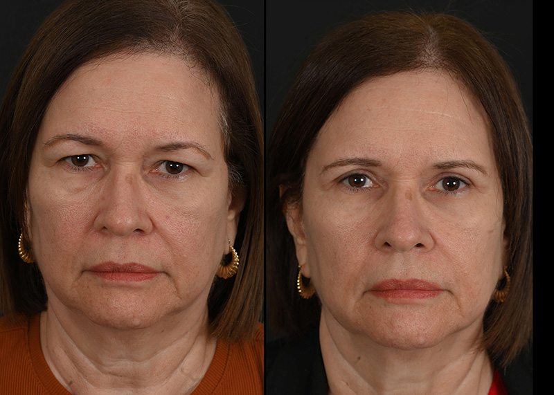 Eyelid surgery patient, before and after blepharoplasty by Houston facial surgeon Dr. Michel Siegel