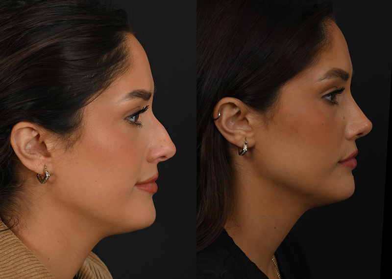 Rhinoplasty patient, before and after rhinoplasty by Houston facial surgeon Dr. Michel Siegel