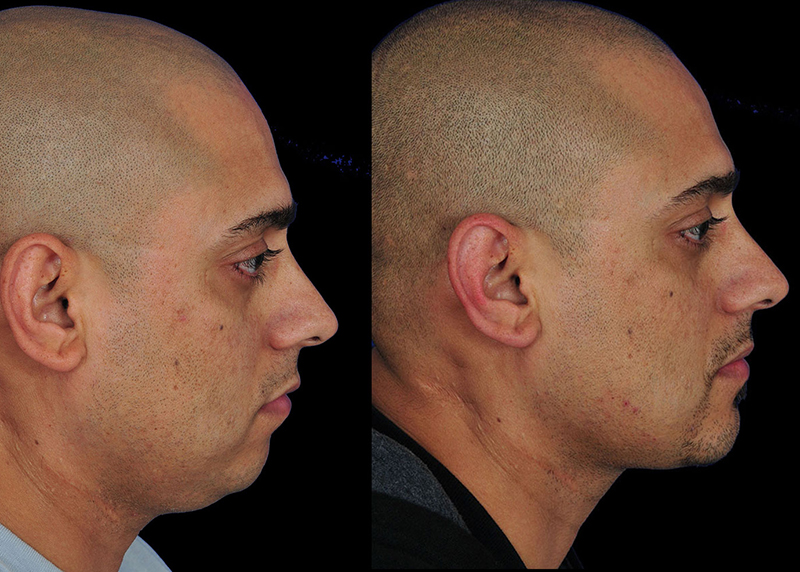 Chin surgery patient, before and after chin surgery by Houston facial surgeon Dr. Michel Siegel